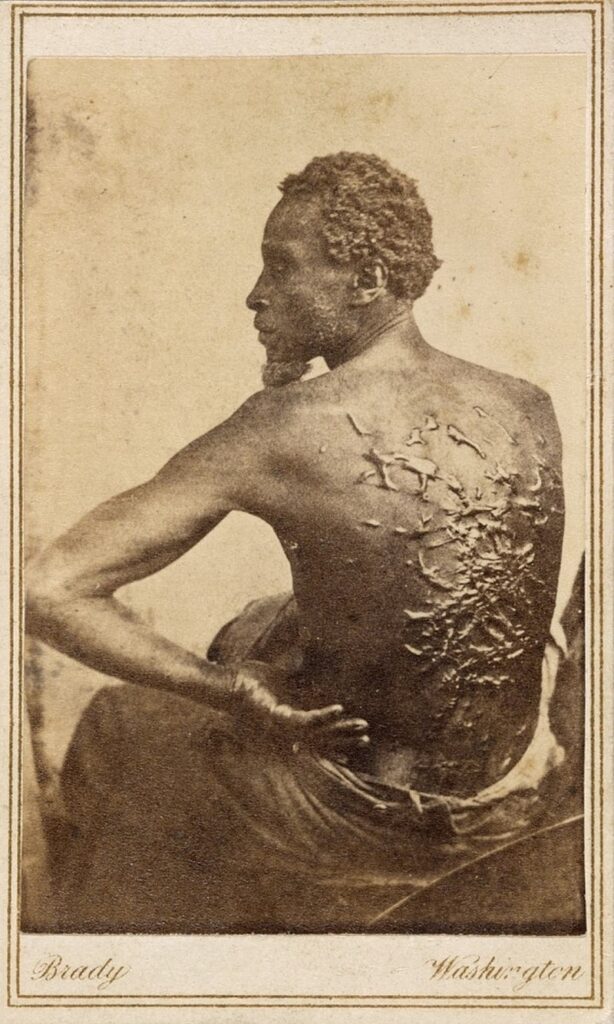 Известная фотография беглого раба Гордона со следами от плети на спине, 1863 год